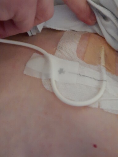 Pn-Patient-Lisa-Catheter